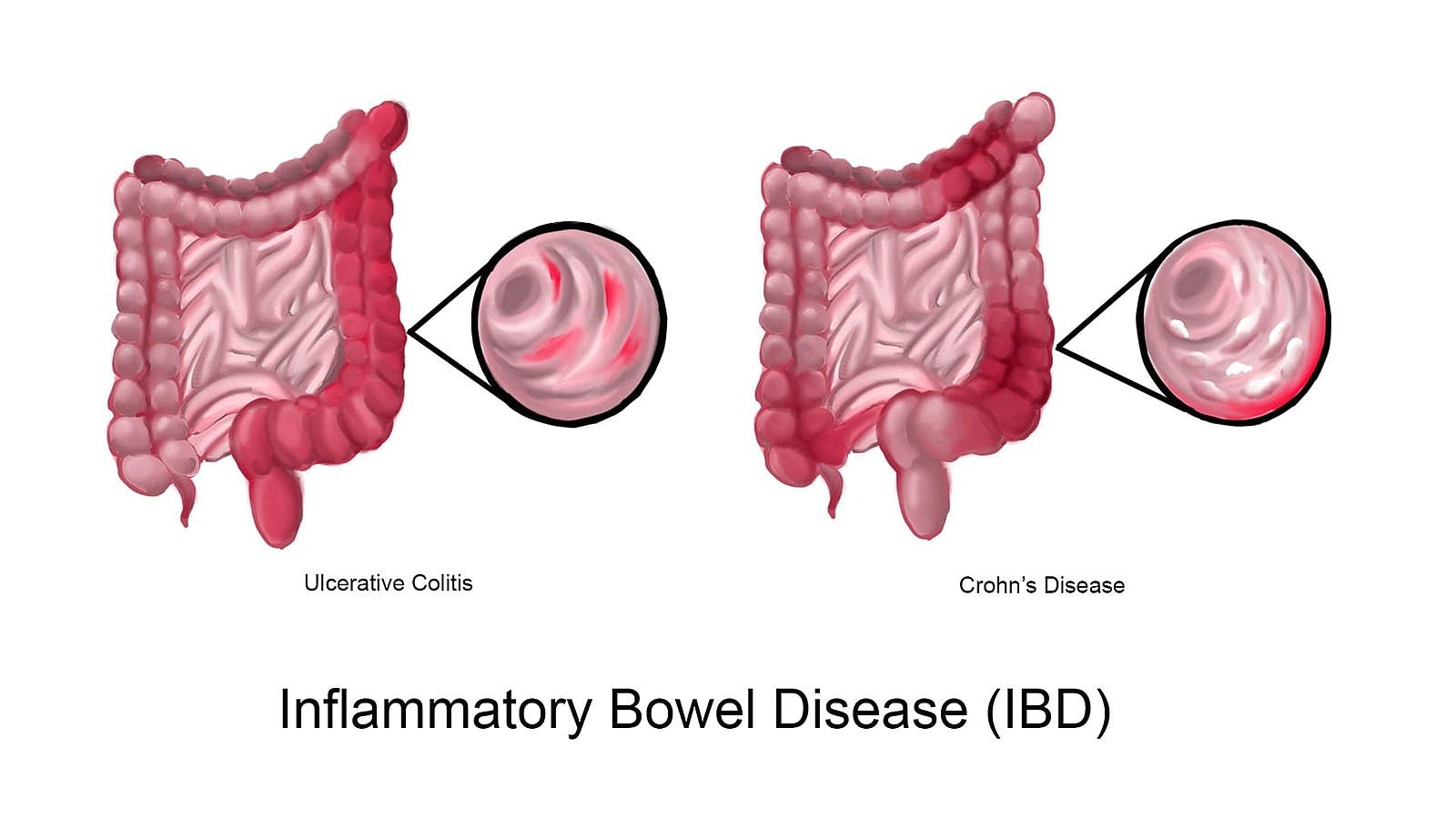 WOLFPACKBME / CC BY-SA 4.0
From 1990 to 2021, global IBD incidence doubled, with more than 3 million Americans now living with the disease.