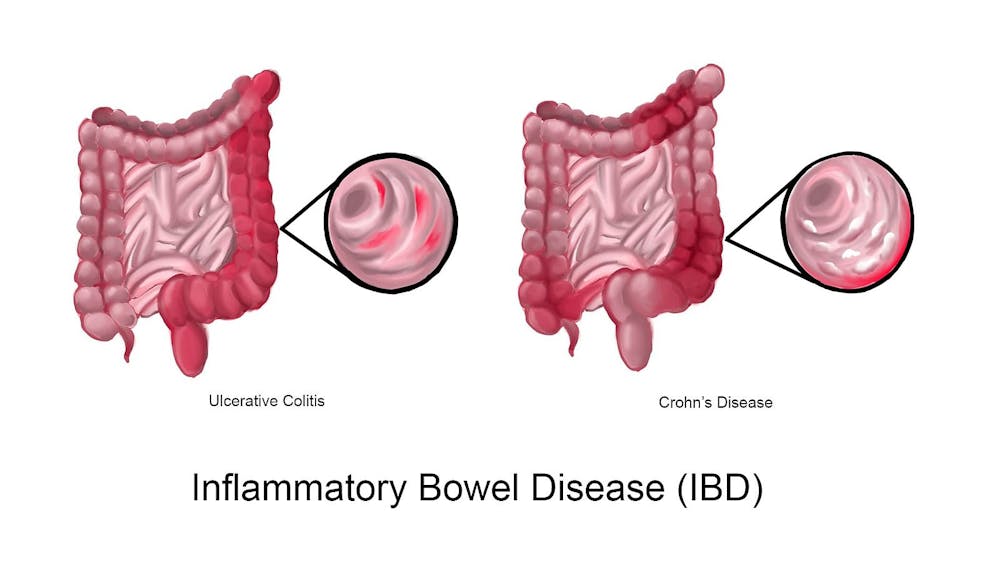WOLFPACKBME / CC BY-SA 4.0
From 1990 to 2021, global IBD incidence doubled, with more than 3 million Americans now living with the disease.