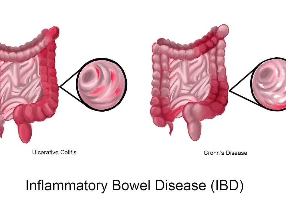 WOLFPACKBME / CC BY-SA 4.0
From 1990 to 2021, global IBD incidence doubled, with more than 3 million Americans now living with the disease.
