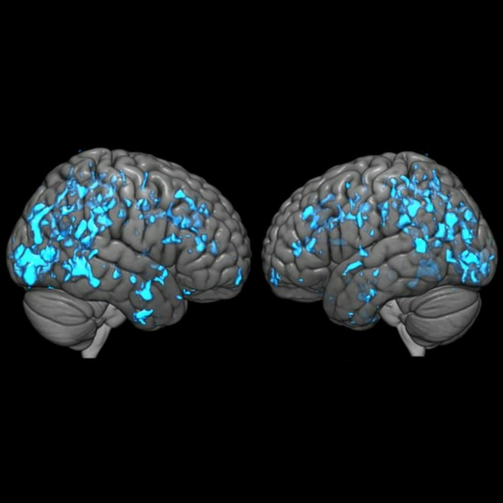 COURTESY OF GWENN SMITH
The blue areas are the regions of Parkinson’s disease patients after treatment with deep brain stimulation, where an increase in dopamine is associated with an increase in glucose metabolism.&nbsp;