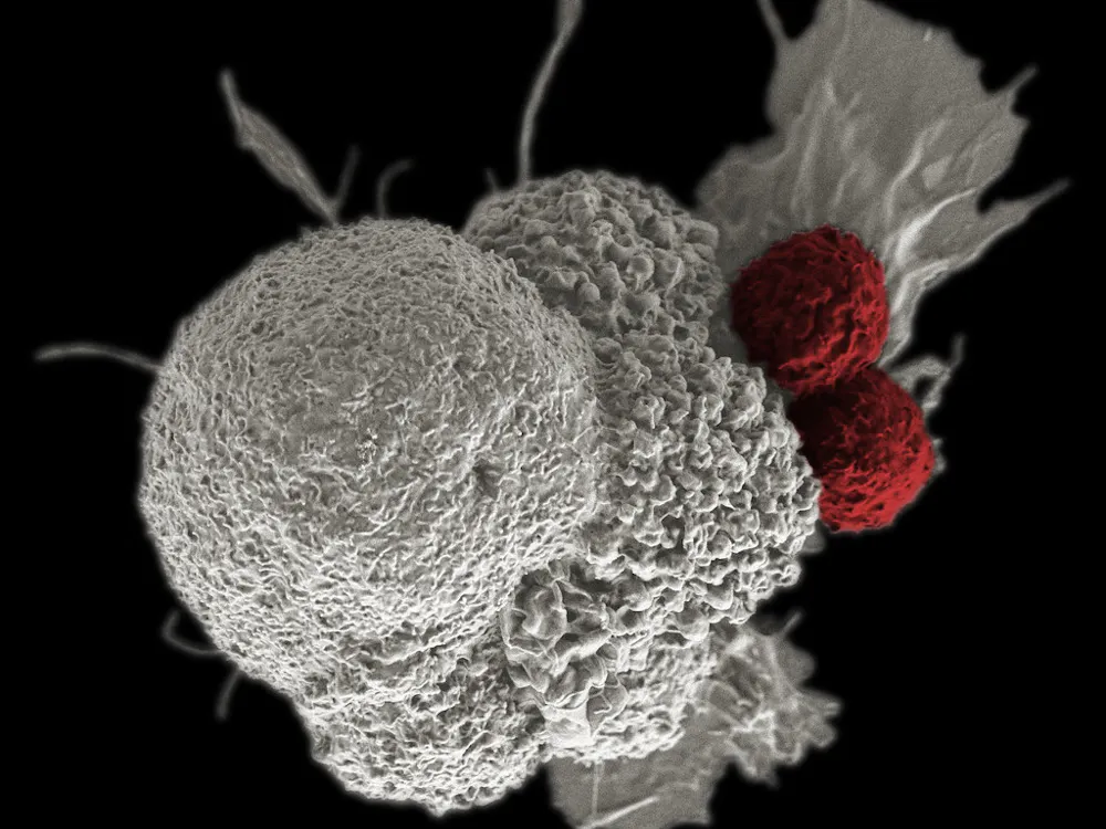 NIH Image Gallery / CC BY-SA 2.0
Researchers at the Sidney Kimmel Comprehensive Cancer Center identified a subset of macrophages that interact closely with breast cancer cells responsible for metastasis. 