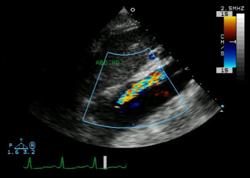 aortic-dissection-echocardiogram-longitudinal-view-color