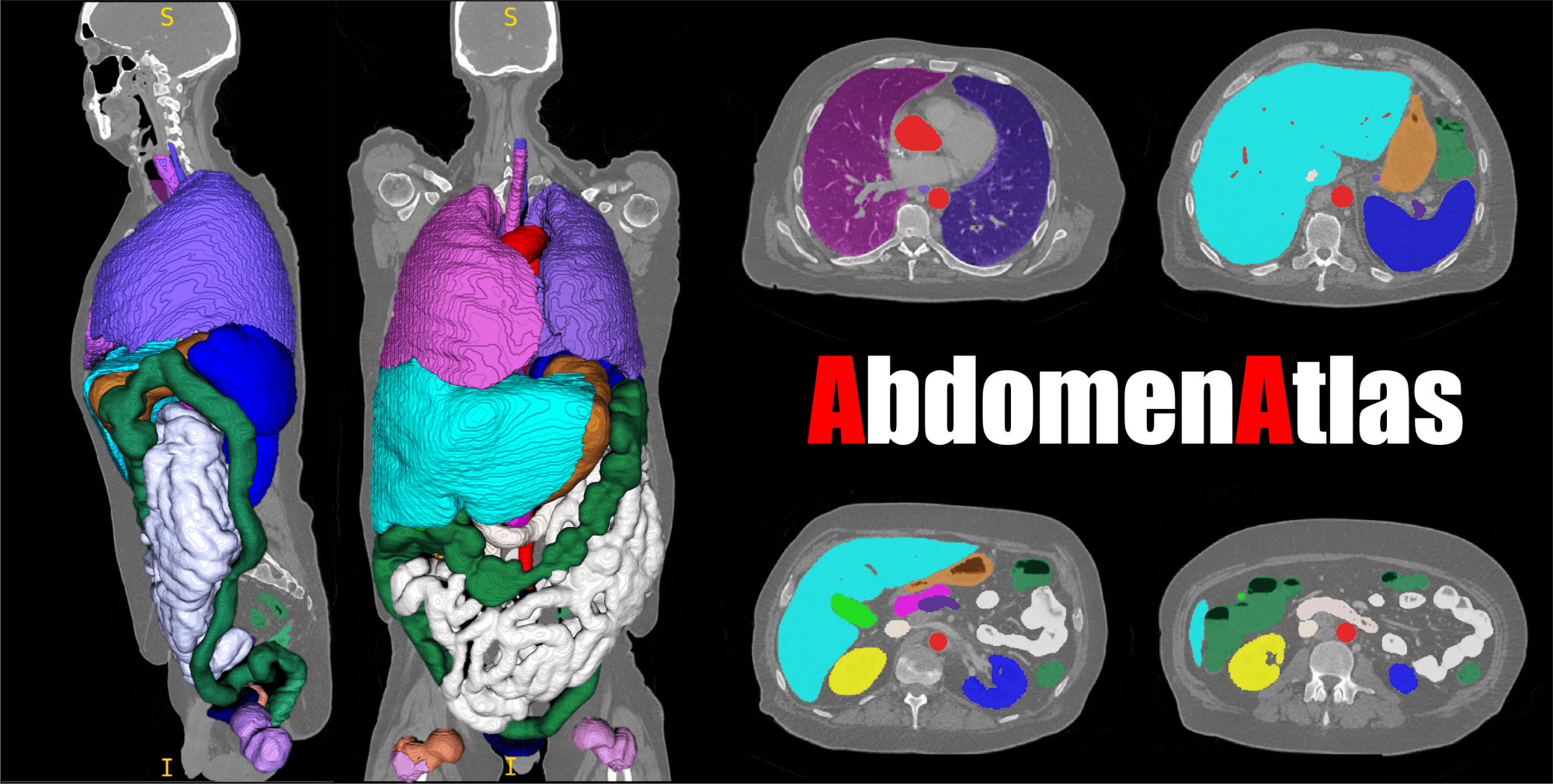 COURTESY OF ZONGWEI ZHOU&nbsp;
AbdomenAtlas is an extensive dataset of 3D reconstructed and annotated abdominal CT scans that can be used to train AI technology on identifying cancer.&nbsp;