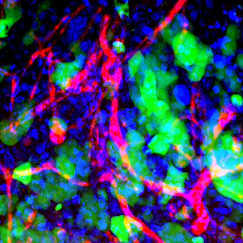 nanoparticles-in-brain-metastases-26155288848