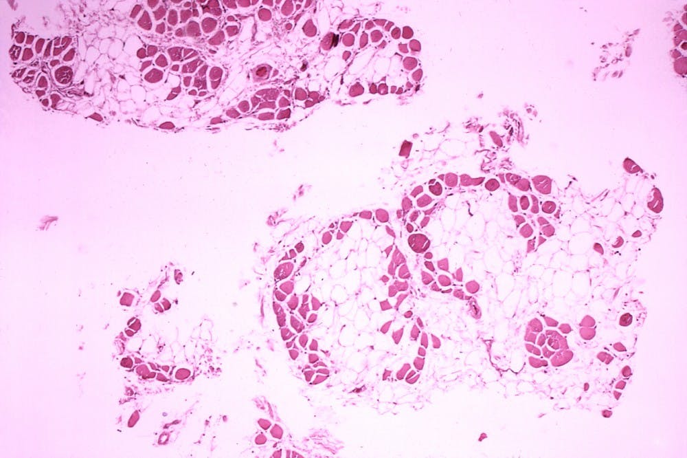 B8_dystrophy