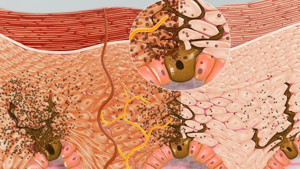 Scientific Animations/CC BY-SA 4.0
Extra mitochondrial iron due to Friedrih’s Ataxia increases risk of cell death from UVA rays.