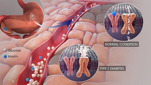 SCIENTIFIC ANIMATIONS / CC BY-SA 4.0
A woman underwent stem cell therapy for type 1 diabetes which was recently confirmed to fully reverse her disease.&nbsp;