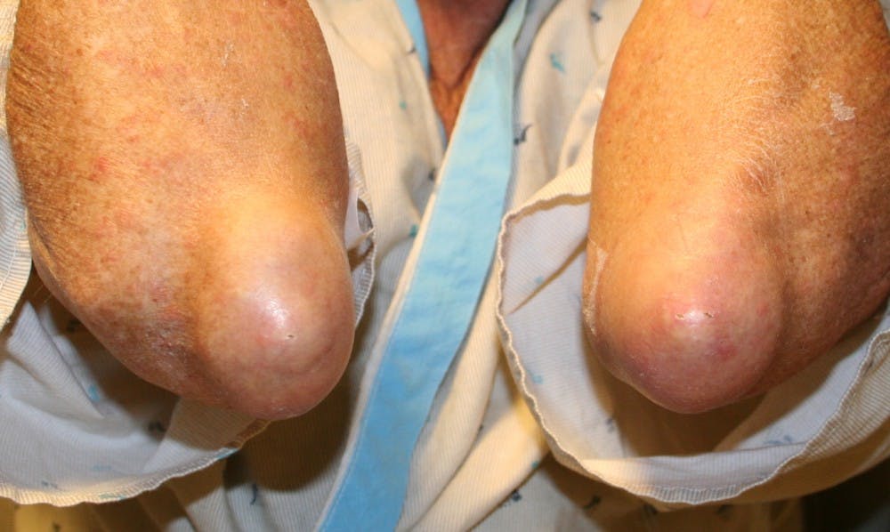 COURTESY OF WWWDERMATLAS.MED..JHMI.EDU
The swelling associated with gout can cause extensive joint pains.