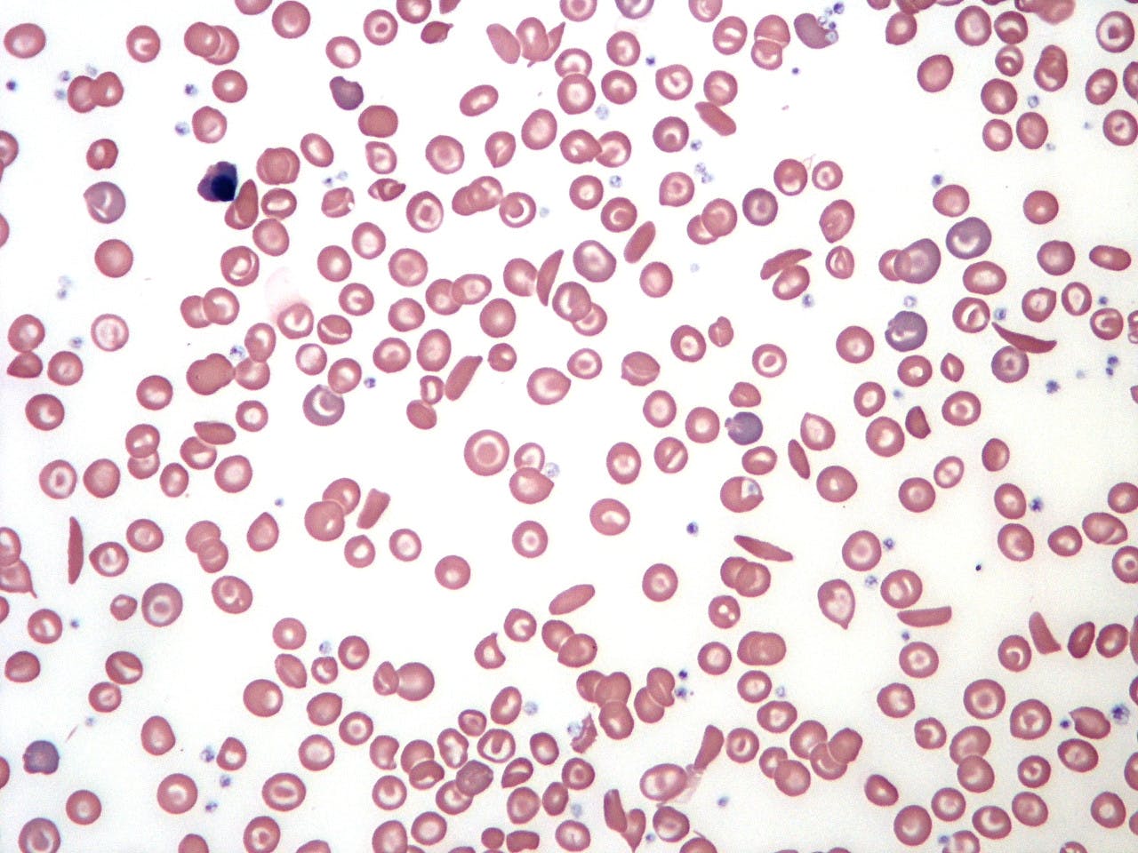 WIKIMEDIA COMMONS / PUBLIC DOMAIN
Hopkins researchers recently developed a “reduced intensity haploidentical” bone marrow transplantation method to cure sickle cell disease.