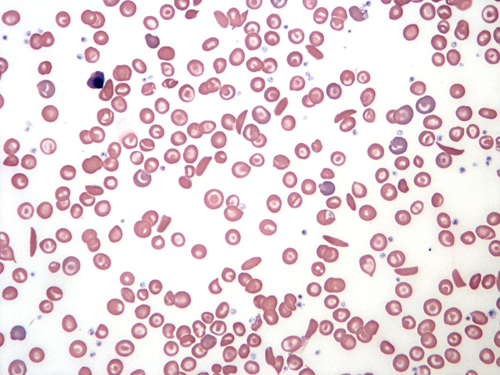 sickle-cell-blood-smear