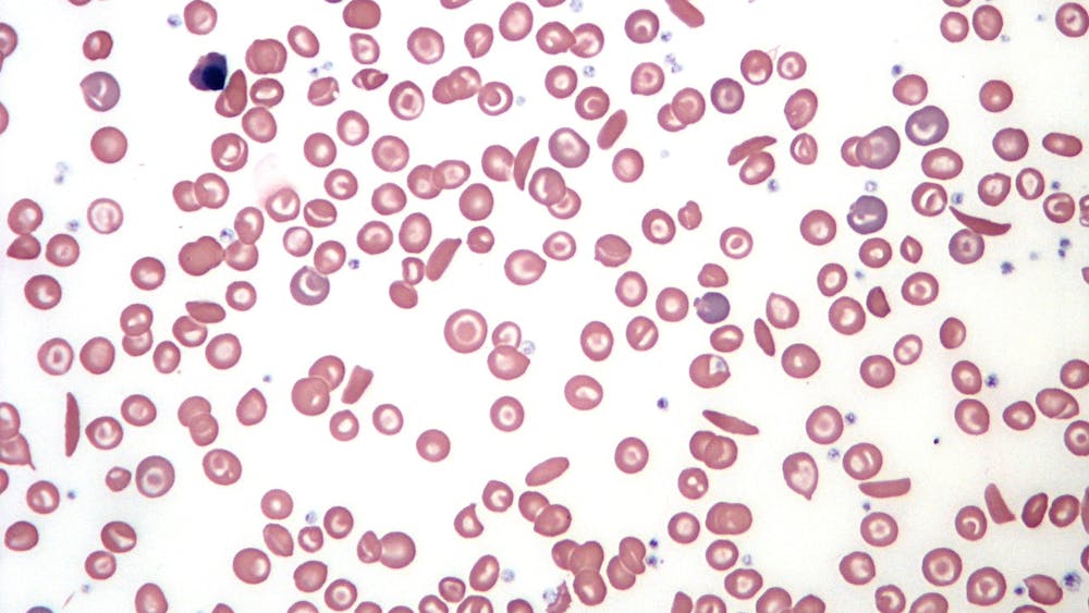 WIKIMEDIA COMMONS / PUBLIC DOMAIN
Hopkins researchers recently developed a “reduced intensity haploidentical” bone marrow transplantation method to cure sickle cell disease.