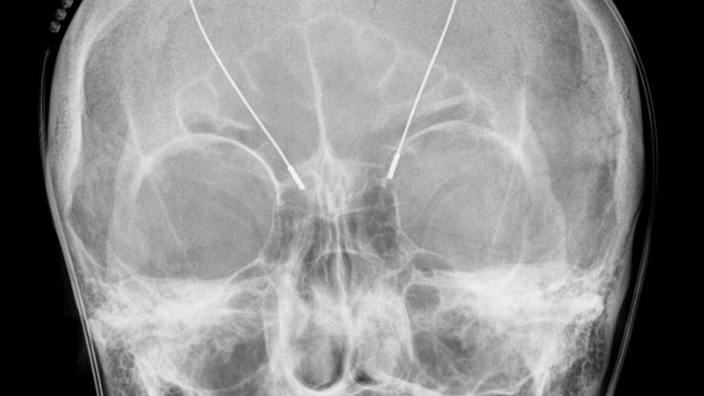 HELLERHOFF/ CC-BY--SA-3.0
This x-ray shows DBS probes attached to the head of a patient.