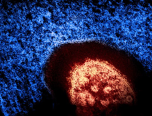 Electron micrograph image of the measles virus in red from the CDC. (Photo courtesy of Wikimedia Commons).