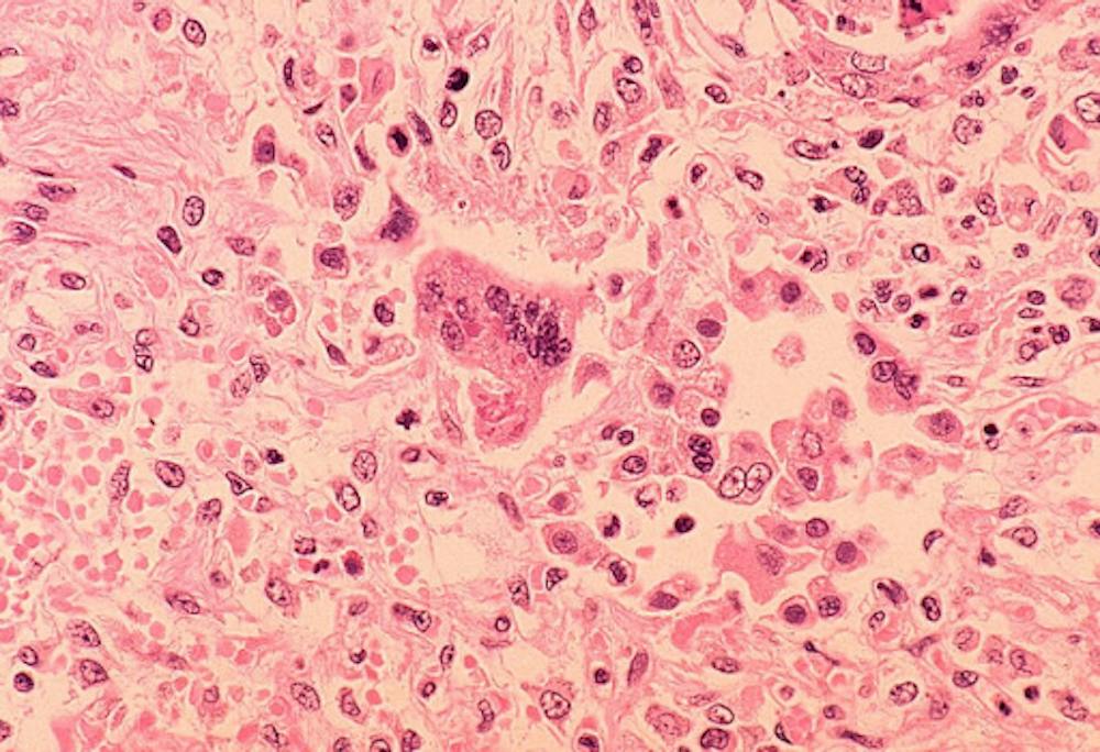 <p><em>Measles pneumonia causes lung cells to fuse into giant &quot;super-cells&quot; containing visible clumps of viral material. (Photo courtesy of </em><a href="https://commons.wikimedia.org/wiki/File:Measles_pneumonia_-_Histopathology.jpg" target=""><em>Wikimedia Commons</em></a><em>)</em></p><p><br/><br/></p>