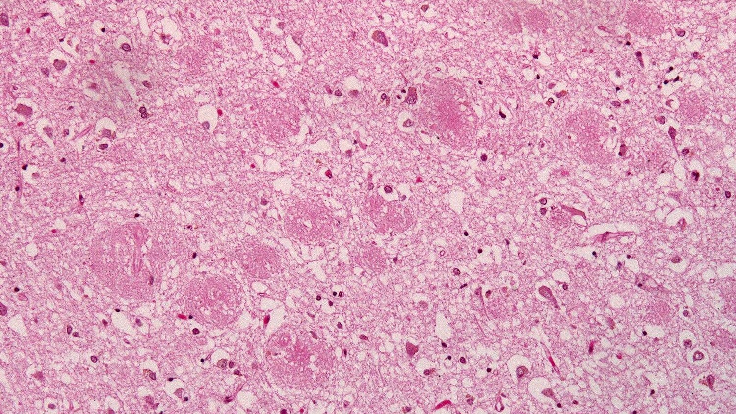 amyloid plaques.jpeg