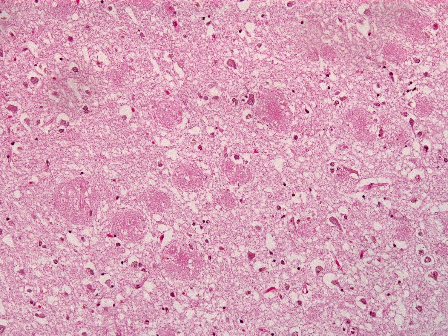 amyloid plaques.jpeg