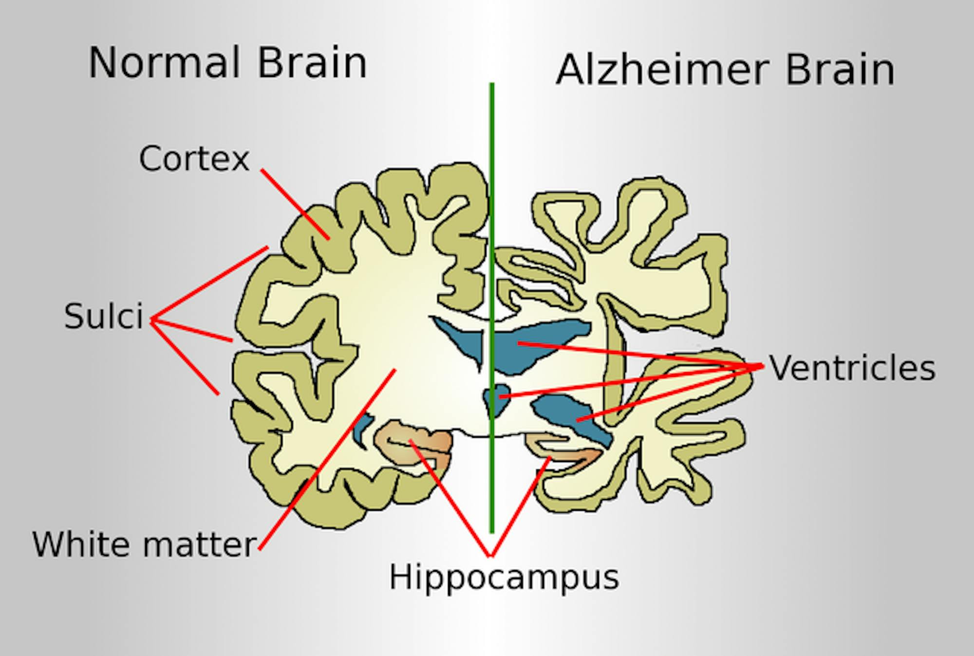 640px-Brain-ALZH