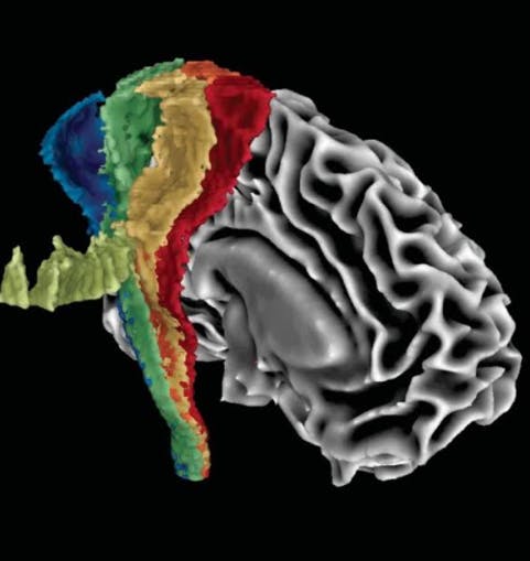 Derek Archer developed a template to differentiate between Parkinson's and related diseases, illustrated here as used in the research team's automated imaging differentiation of Parkinsonism machine.&nbsp;