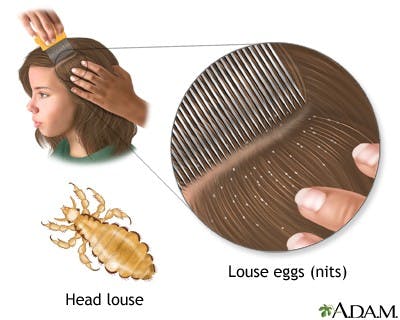 images of lice in hair