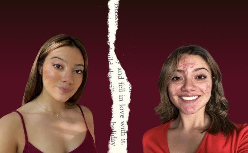 STAFF OPINION: A love letter to my acne
